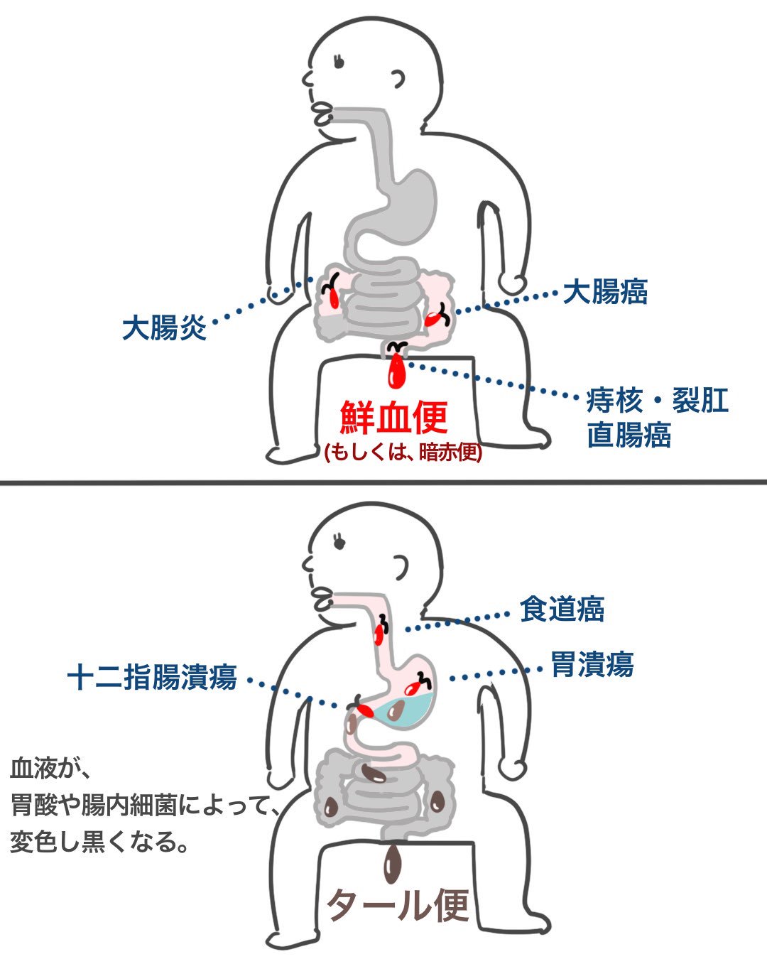 ゴロ 解剖生理イラスト パッと見で覚える 鮮血便 と タール便 の違い T Co Xarutgnqwn Twitter