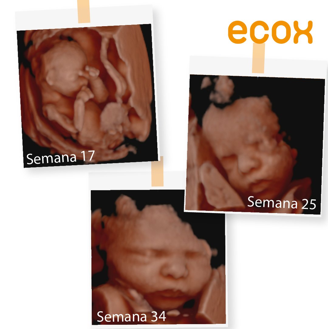 Tu peque crece cada día, poco a poco. Así va cambiando a lo largo del embarazo/Semana 17, ya puedes saber si es niño o niña/Semana 25, notas sus movimientos al comer/Semana 34, ¡ya queda poco! ¿A quién se parece más? #ecografia #bebe #embarazo #embarazada #sesionembarazo #ecox