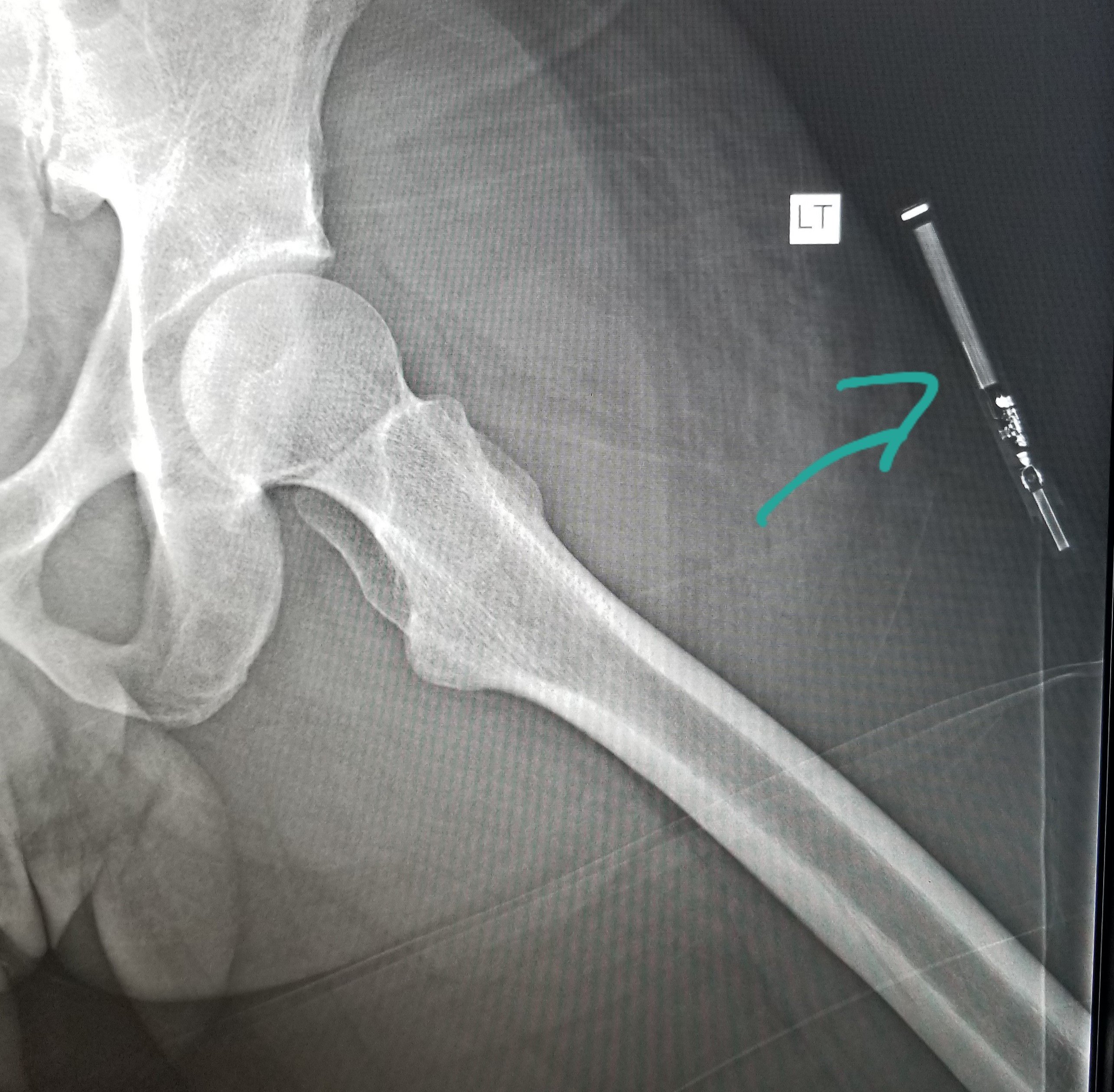 Do Vape Cartridges Show Up on X-ray?