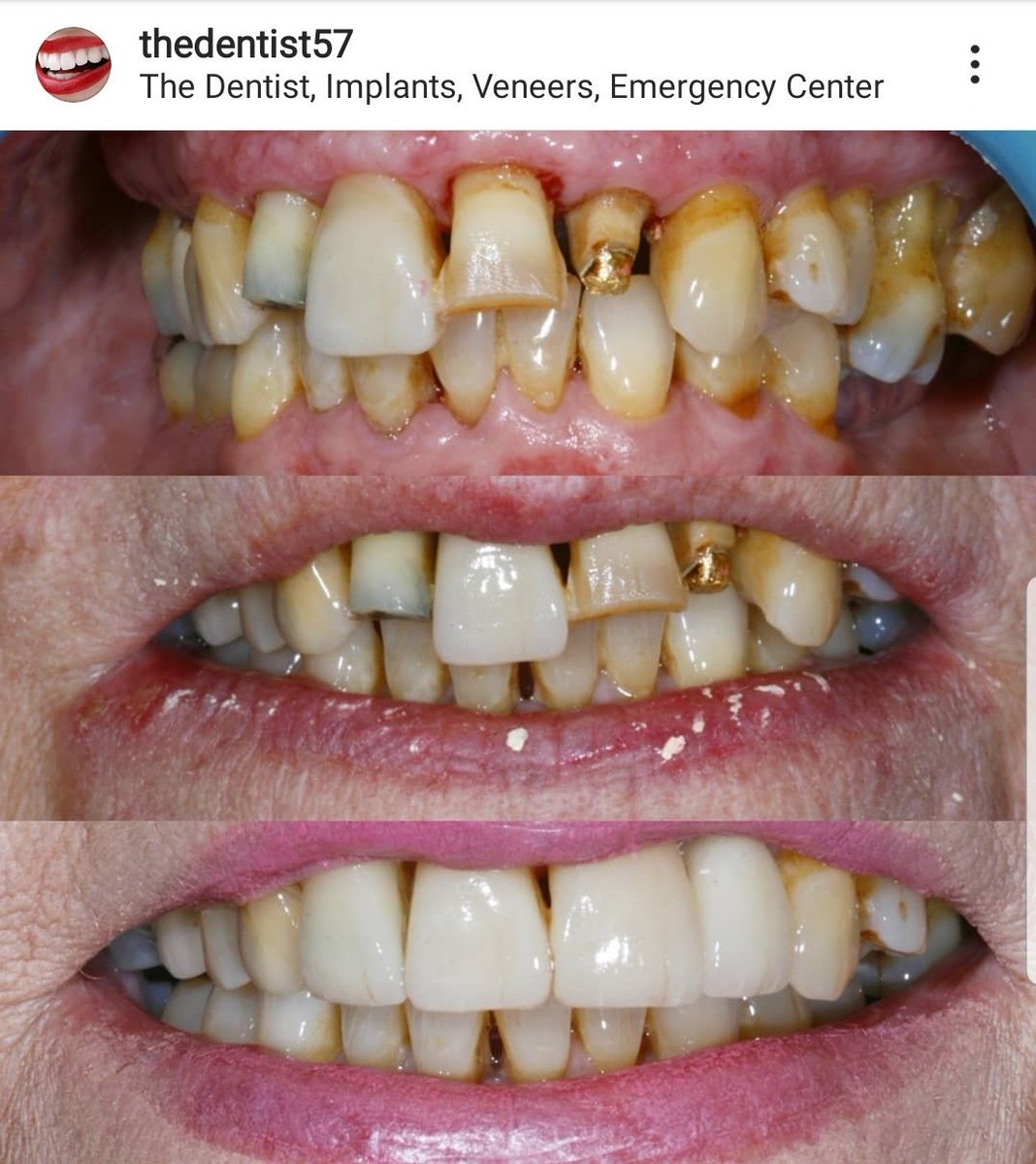 Before &amp; after picture of a patients front four veneers and full mouth whitening treatment. Very satisfied patient with the outcome. 🦷
#TheDentistWestMidlandsWalsall#Whitening#Emax#Smile#DrDhody#Transformation#PatientLovesThisSmile