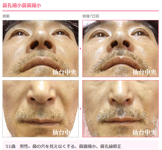 鼻翼拡大 鼻翼拡大