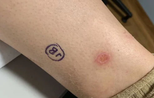 ScreenCancer UK on Twitter: 