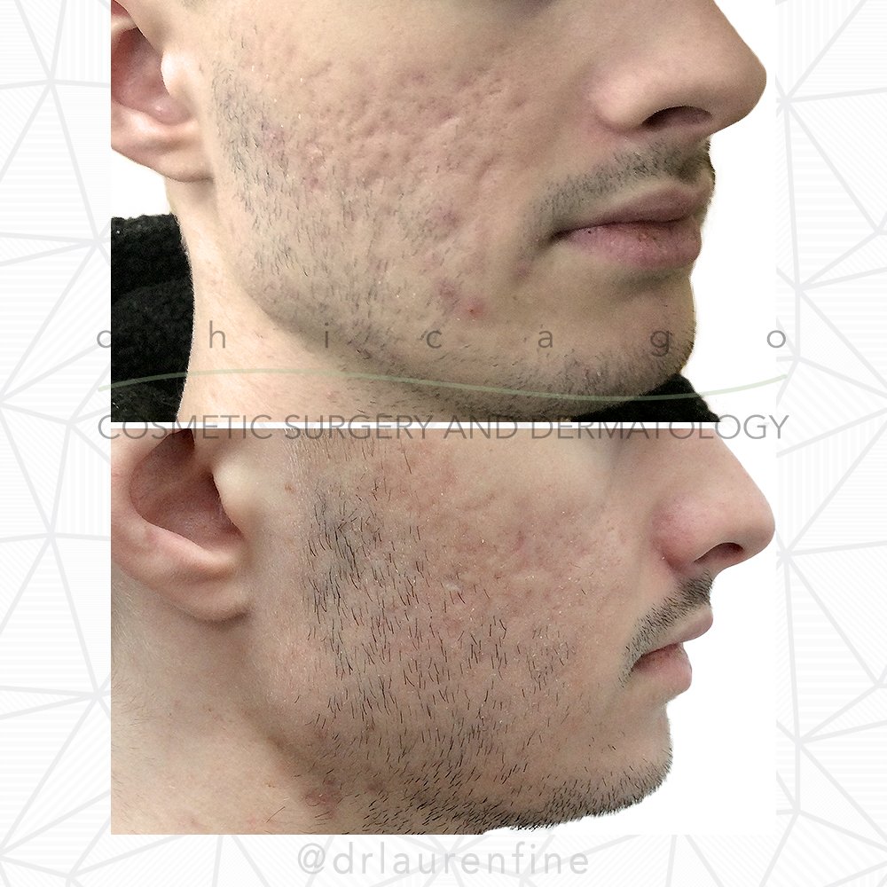Acne Scars before And After Astonishing Transformations 2023 Your