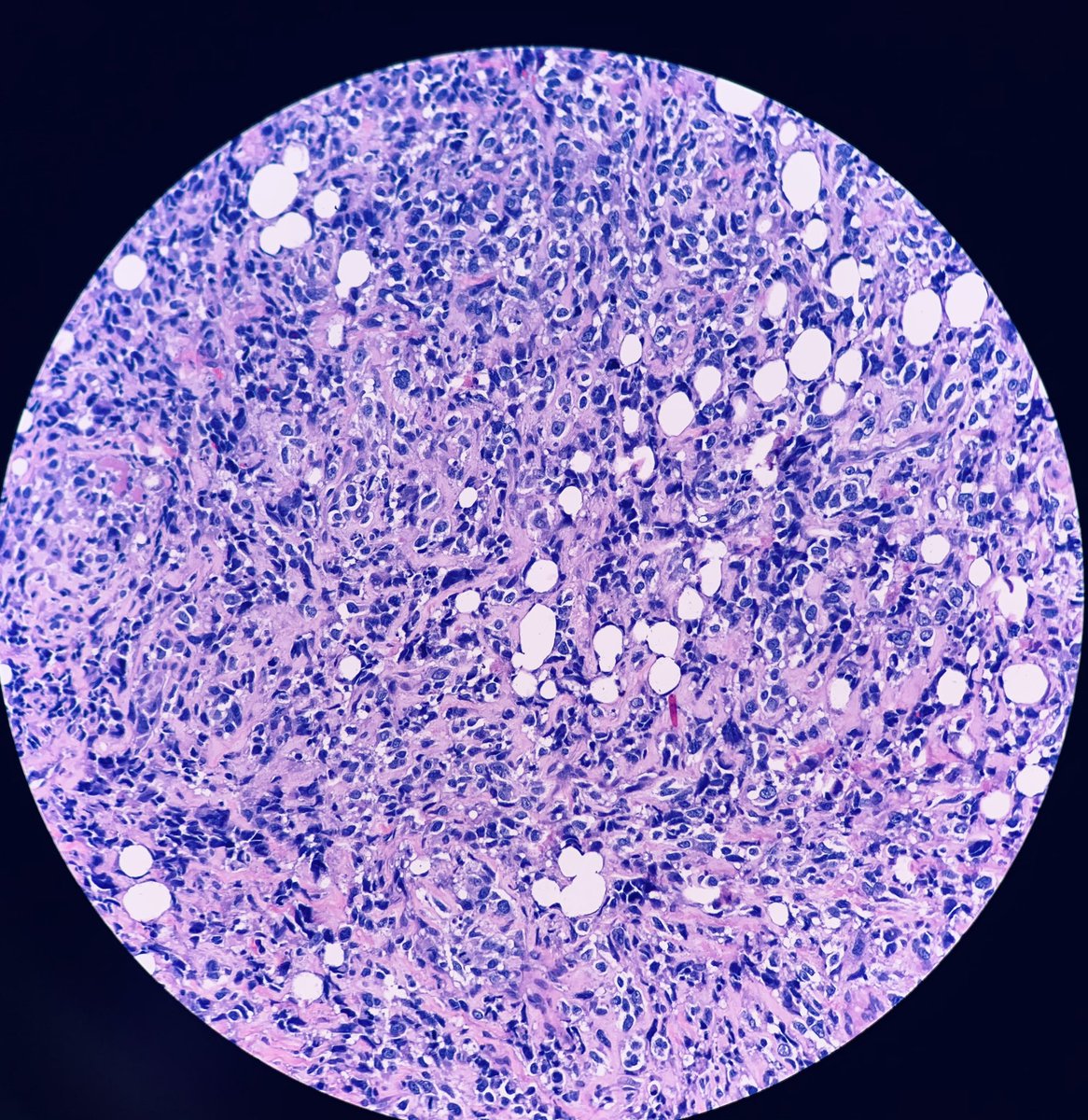 HENRYY_MD's tweet photo. 68 F。 chest lesion. #Dermpath #pathology #toughcookies https://t.co/kXBVSUkNC3