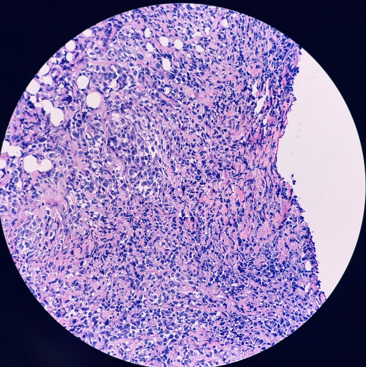 HENRYY_MD's tweet photo. 68 F。 chest lesion. #Dermpath #pathology #toughcookies https://t.co/kXBVSUkNC3