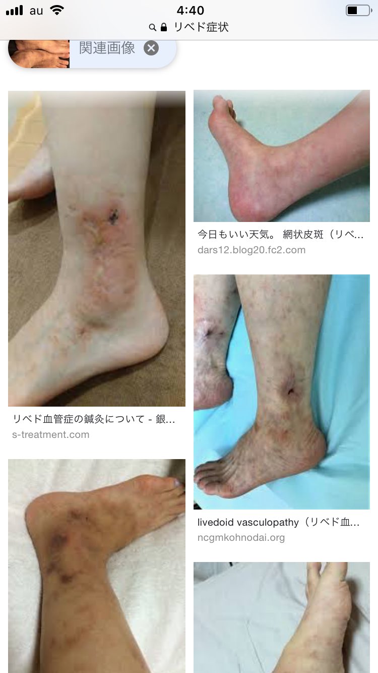 野村俊一 難治性血管炎 に関する調査 皮膚血管炎と鑑別が必要な疾患 リベド様血管症 網状皮斑 リベド を皮膚症状の主体として 時に 皮膚潰瘍 を伴い 萎縮性白色調の 瘢痕 を残す 検査では 抗リン脂質抗体 が陽性となる場合がある 引用元