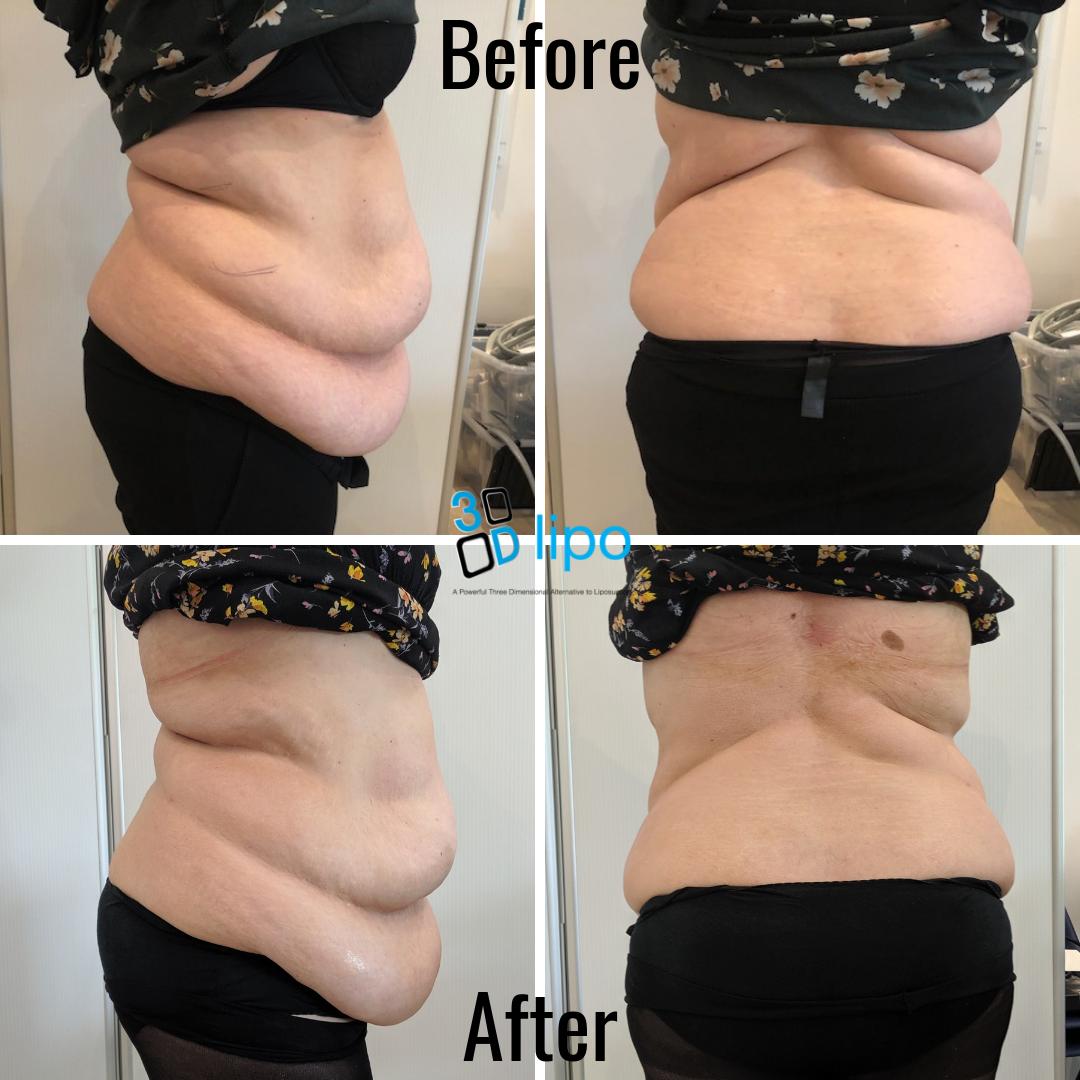 “I have just completed my 8 treatments as a model at 3D-lipo Ltd and the results are massive- I’ve lost 28 cm from my torso area! Since having the treatments I’m also drinking a lot more water, so not only have I lost weight, but I’ve also seen an improvement in my skin!”