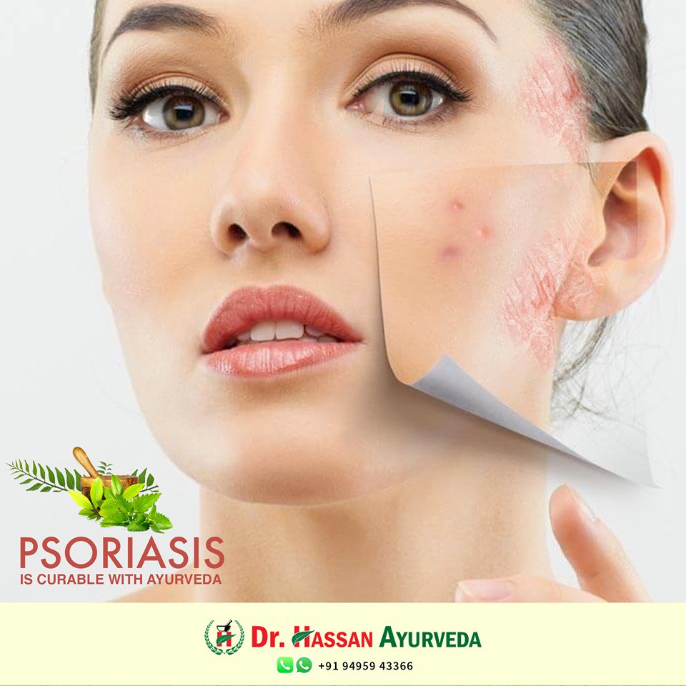 Dr Hassan Ayurveda Hospital on Twitter "Psoriasis is curable with
