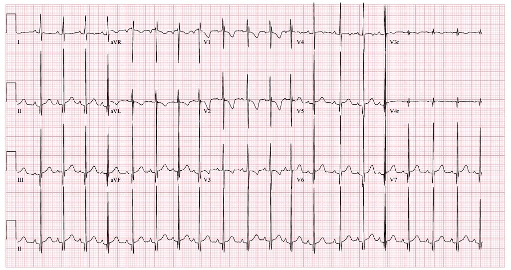American College of Cardiology tweet media