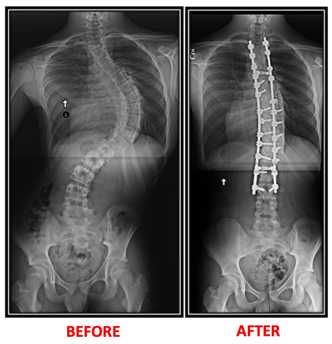 VSI_SPINEMD's tweet photo. This superstar Spinal Champion is back to playing college lacrosse after spine surgery!See where he began his journey (before/after x-rays). We applaud Christian’s determination & drive to get back to🥍
#Spinesurgery #SpinalChampion #scoliosis #GetBackto #VirginiaSpineInstitute https://t.co/WW1yXwmnSy