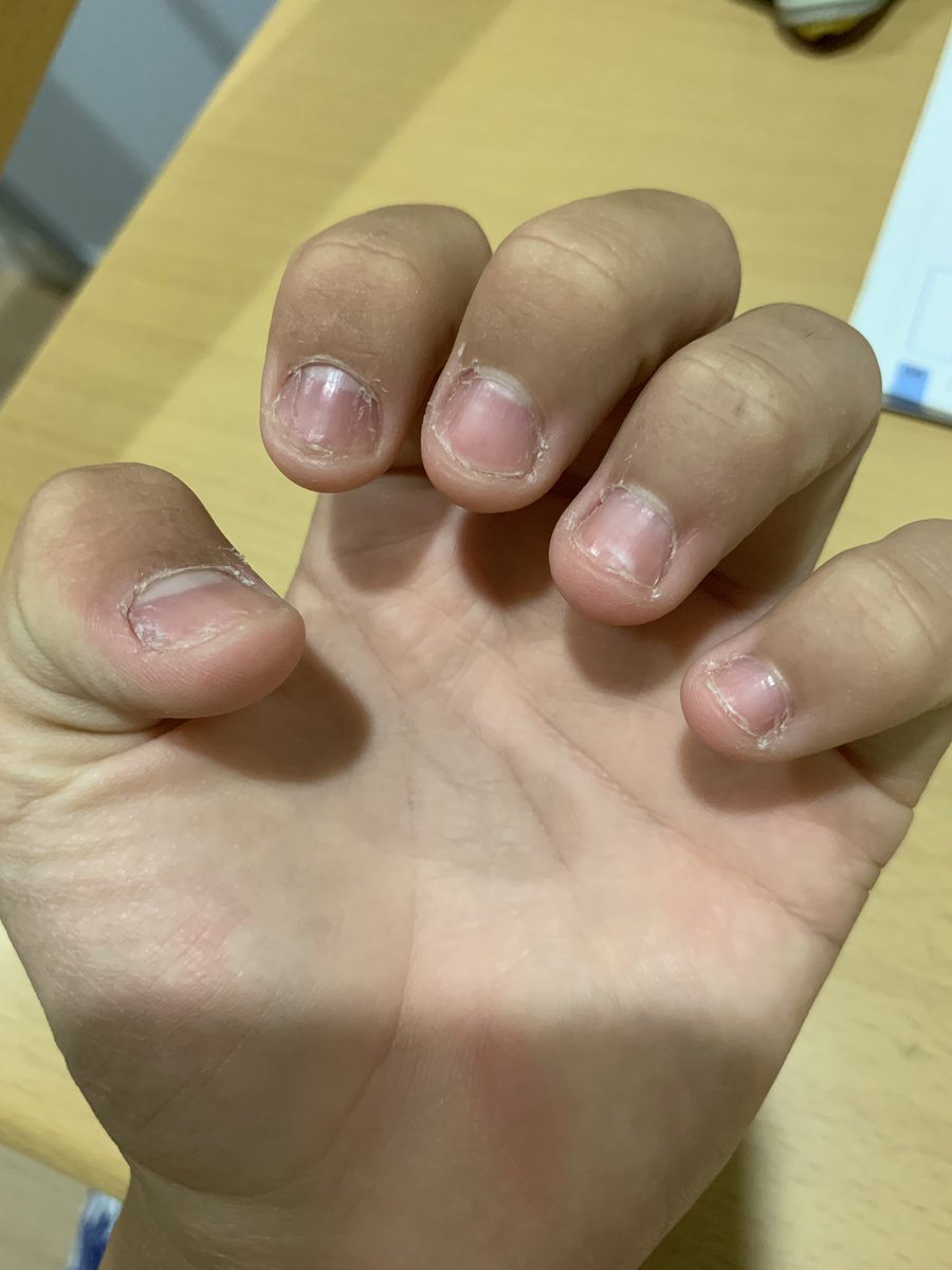 爪の噛み癖 爪の噛み癖
