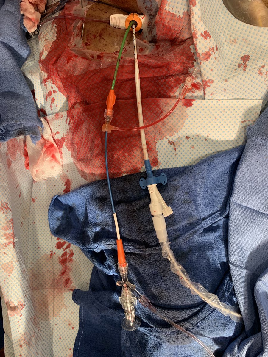 TimDSmithMD's tweet image. Usually I prefer #RadialFirst CHIP approach with femoral @abiomedimpella  rather than #singleaccess to have site control if needed.  But, chronic HD pt needing 1.75 rota burr via 7Fr does make for a nice trick up the sleeve.#CardioTwitter