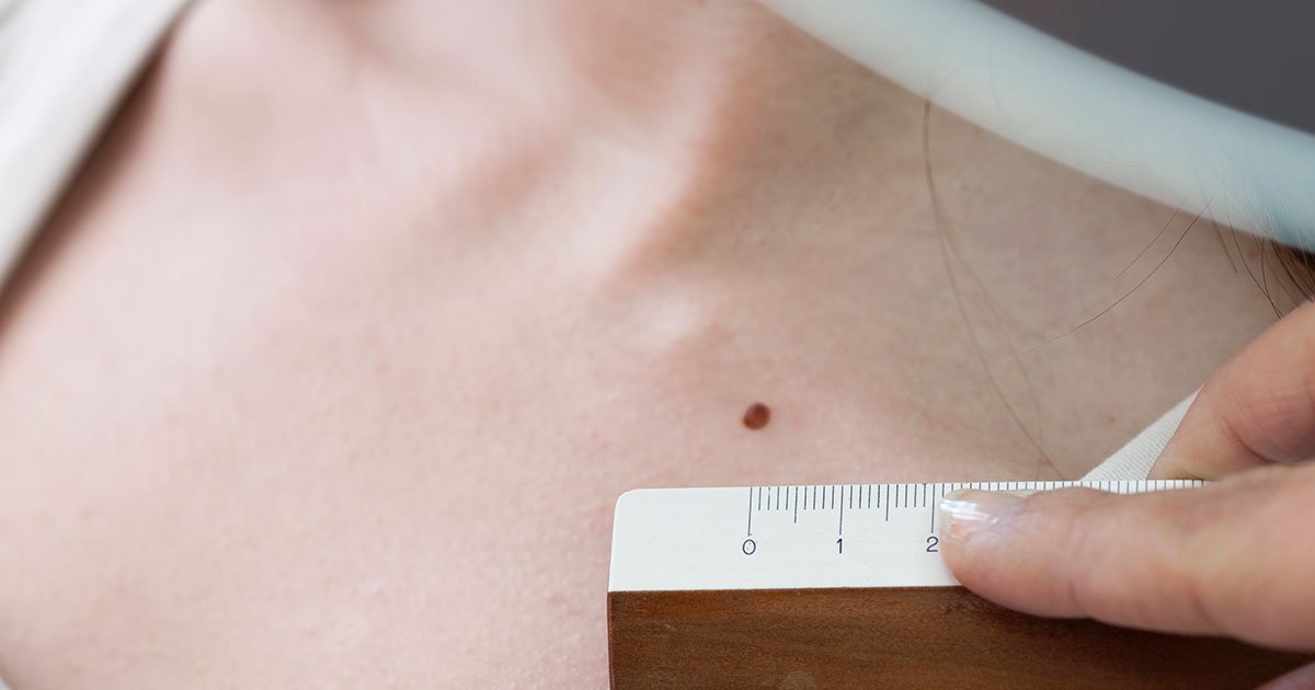thedermgroup's tweet photo. How often should you have a skin exam?

Marc Glashofer, M.D., skin cancer surgeon, explains the age he recommends people begin having regular skin exams and risk factors associated with skin cancer.

Read the article from SHAPE: https://t.co/qIMN9Ygl5D https://t.co/oRrwIhBcx5