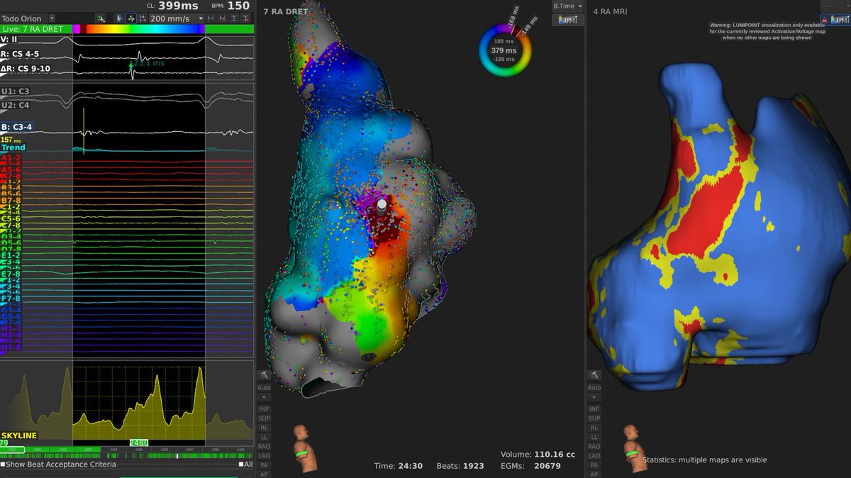 ivroca's tweet photo. Redo procedure with @LluisMont2. Mapping with @rhythmia and lumipoint. Gap in the LIPV also detected by @ADAS3D @GalgoMedical in the post ablation CMR. Isolation of LIPV (1shot) and mapping of right atrial flutter between 2scars also in the CMR (@ADAS3D). Imaging and mapping!! https://t.co/uNrKQf5OPF