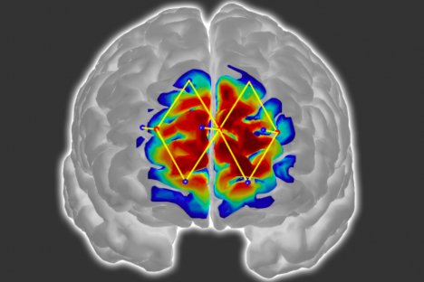 Moving beyond the 1 - 10 scale? Detecting patients’ pain levels via their brain signals bit.ly/2NkK2ll