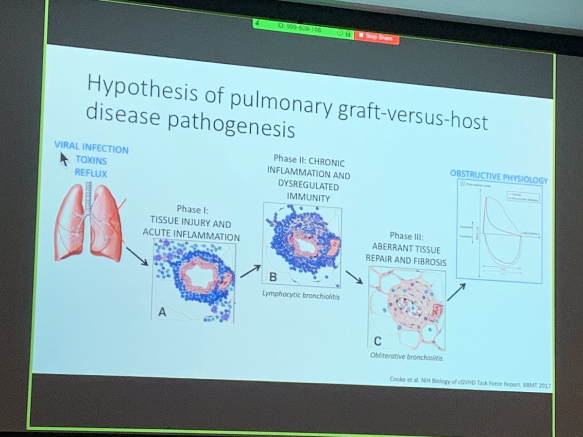 PisaniMAP's tweet photo. Pathogenesis of GVHD-viral infection, injury, inflammation, dysregulation, aberrant repair, fibrosis leads to obstructive lung physiology-Dr Chen @YalePCCSM @PccsmYale #bestformerfellows #statechest https://t.co/LYgSB57mMi