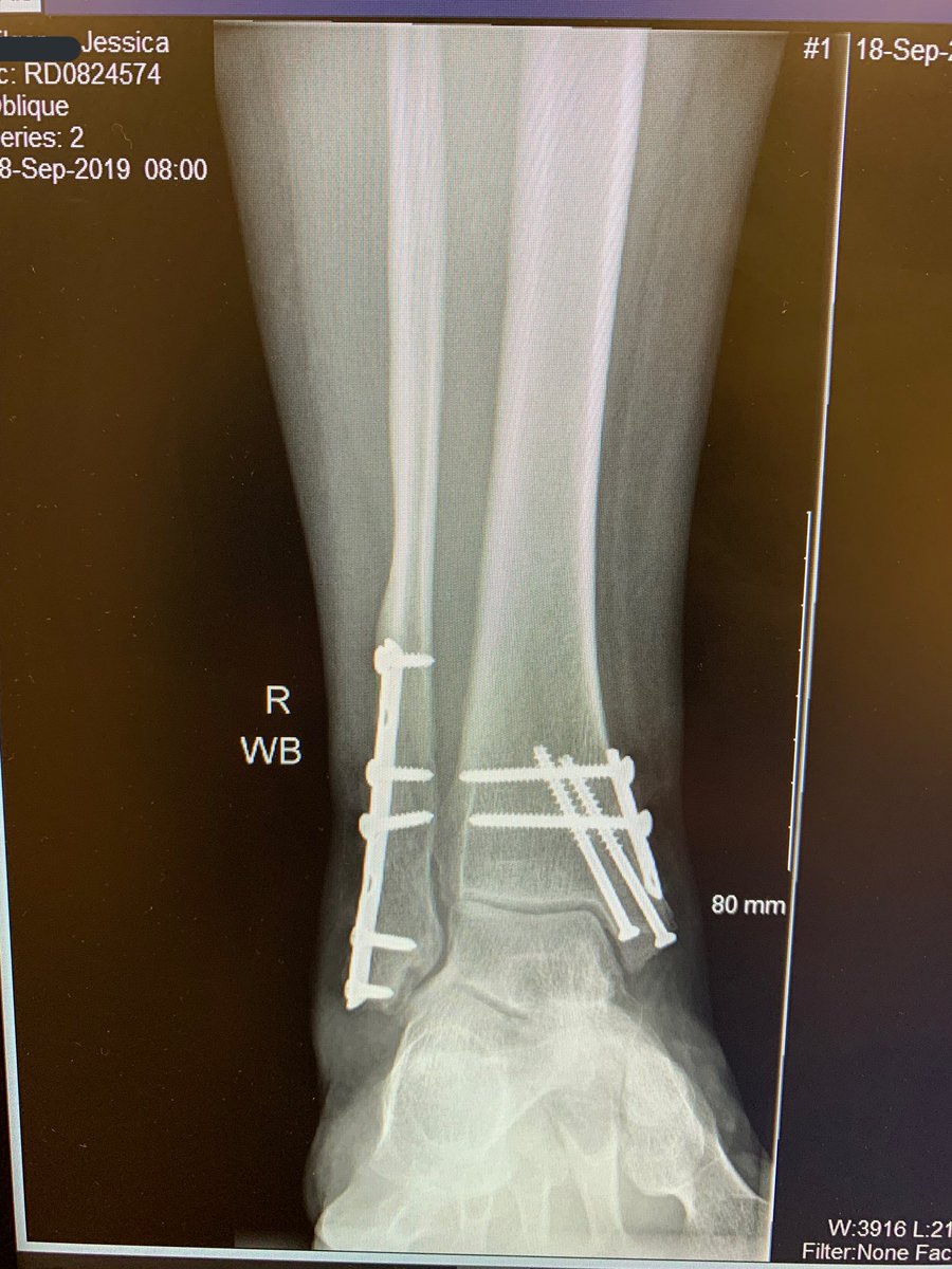 LVLollyPopKid's tweet photo. So, after realizing I was just being paranoid (as usual) about my ankle feeling off.
I present to you my #bionic ankle...770 days after injury. 769 days after surgery.
#trimalleolarfracture #orifsurgery https://t.co/PLTQAPyPN5
