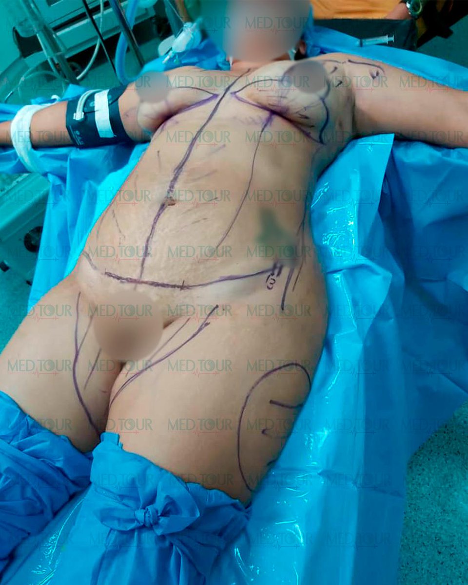 servimediplan's tweet photo. Fantástico resultado 👏👏
#Mastopexia con implantes 360 cc + #Lipoescultura + #Dermolipectomia corporal https://t.co/AAN2HZ1dbS