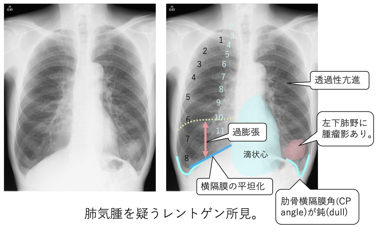 ごろ にゃ 画像診断cafe Ar Twitter 肺気腫のレントゲン所見 肋骨横隔膜角 Cp Angle が鈍 Dull である 横隔膜が平坦化している 両側肺野の透過性が亢進している 過膨張がある といった点を確認しましょう 正常な横隔膜は第10後肋間 第6