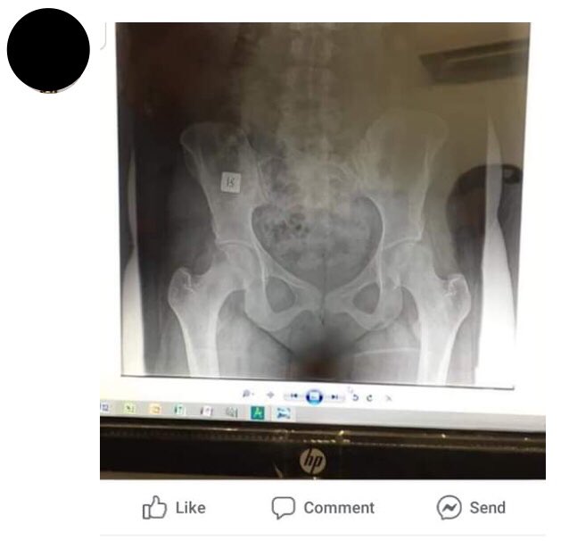 AdamMeakins's tweet image. When some physios who I respect tell me there is no harm with manual therapy I want them to explain posts like this that I get sent by concerned friends

If manual therapy training, treatment and beliefs are not to blame here, then what is? #ManualTherapySucks 😡