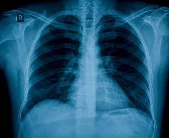 Vaping-related lung injuries resemble chemical burns bit.ly/2nkaJLy
