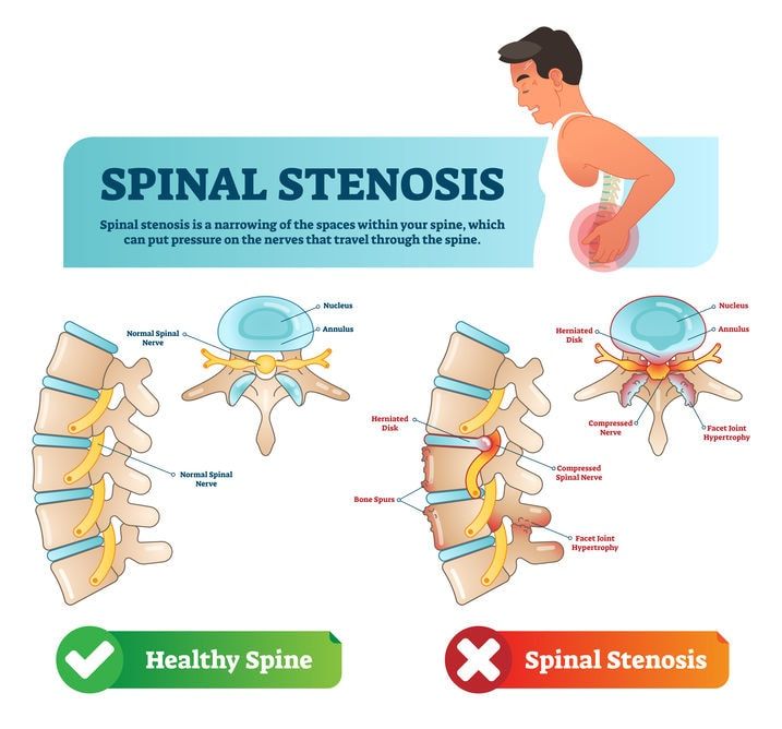 Sciatic Pain Relief tweet media