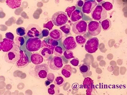 archclincases's tweet photo. Felty's syndrome: read more about this rare condition is this issue of Archive of Clinical Cases. Want to know more? Check out our other articles on our website.
https://t.co/dxPlayFYTx https://t.co/ZnvHlEsgyv