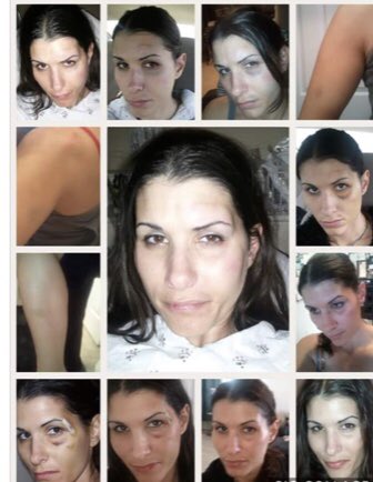31Virtue's tweet photo. In 2012, I was severely beaten when leaving a man I was dating. That was the 1st & last time he assaulted me; concussion; metal plate in my face for a broken cheekbone, perm nerve damage. Judged by many. If you are a victim of DV, DM me for true support. No judgement. #DVIsReal https://t.co/YUEtDaSZUe