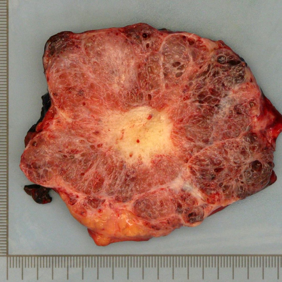 One does not need a microscope to diagnose this pancreas tumor. Book-perfect gross. Honeycombed cut
surface and stellate scar are typical for serous cystadenoma. #SCA #serouscystadenoma #grossonlydiagnosis