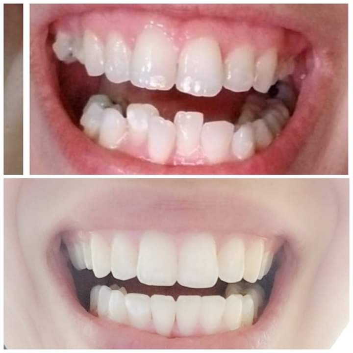 shands87's tweet photo. Definitely pleased with my results. Glad I found an orthodontist that didn't let me down nor tell me that there was nothing he could do. After so many years of  school and getting made fun of i can now smile larger than ever and not hide! Invisalign was worth the wait #Invisalign https://t.co/UfK1NmtMCf