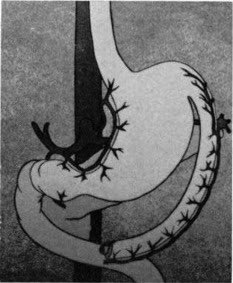 SurgeryLegends's tweet photo. Romanian surgeon Dan Gavriliu (1915-2012) performed the first total surgical replacement of the human esophagus, using a section of the stomach, now called the Gavriliu esophagoplasty. This was on April 20, 1951, but was not well known as it happened behind the Iron Curtain. https://t.co/4cXGsaAnb4