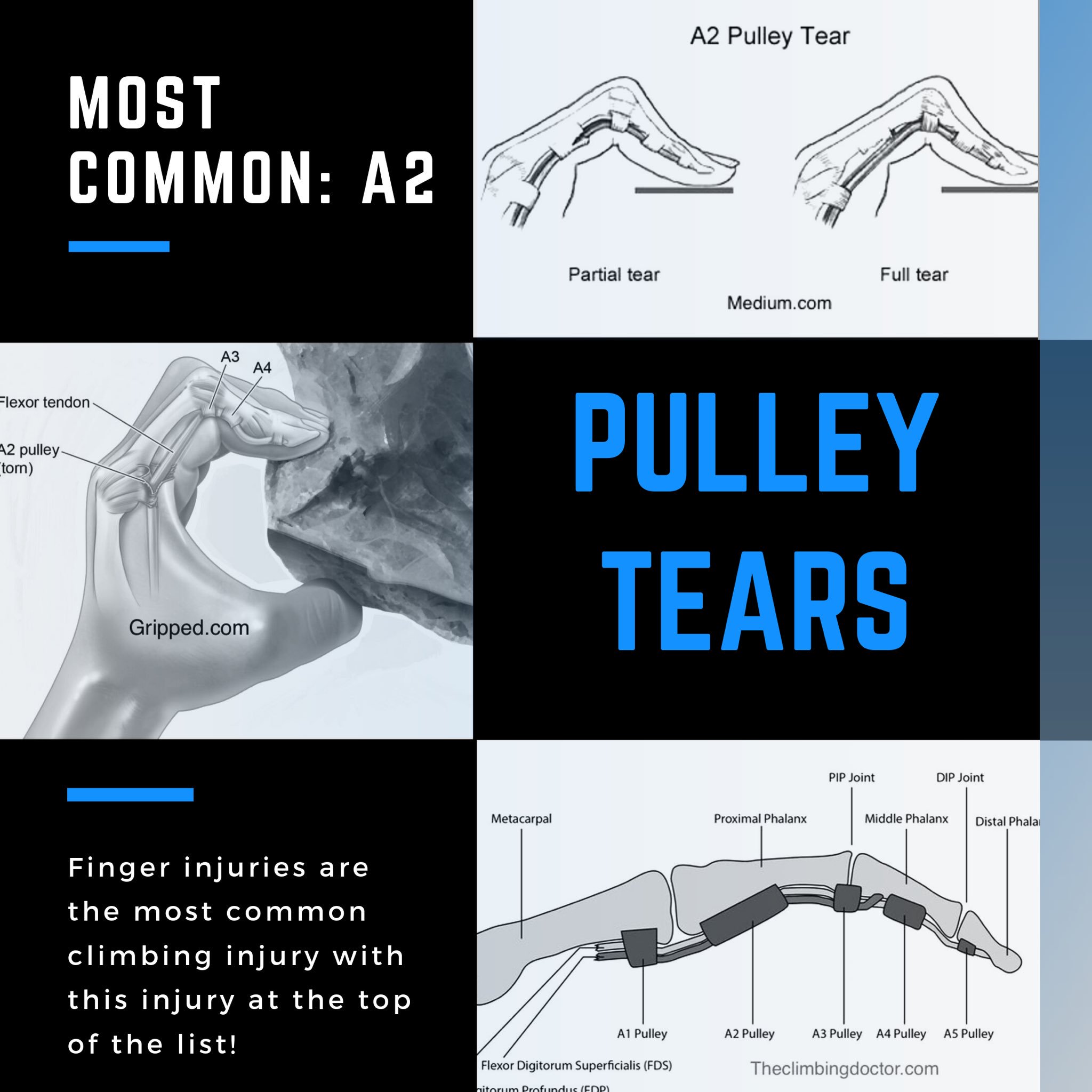 A2 Pulley Tear Up To Date