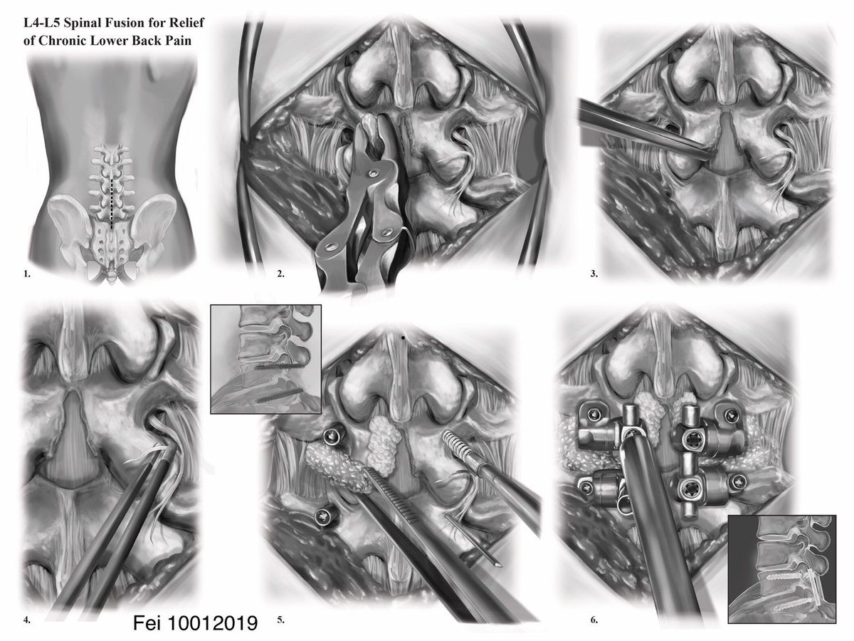 Fehinfei 常飛 Low Key Feel A Bit Dead Inside Since I Have A Ton Of Projects Many Lectures To Get Caught Up On Study For But Here S My 1st Surgical Fehinfei 常飛 Low Key Feel A Bit Dead Inside Since I Have A Ton Of Projects Many Lectures To Get Caught Up On Study For But Here S My 1st Surgical
