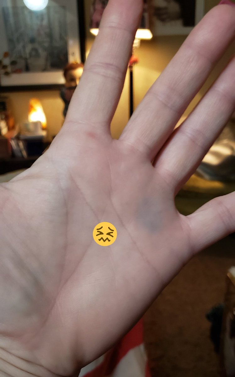 themistressnoir's tweet photo. See all the blue marks on my hand😳those are bruises from me grabbing my stair rail as I lost my footing on my stairs. 10+ years I've lived here and never once biffed on my stairs. Totally fu*ked... cuz it's my spanking hand! #biffedit #themistressnoir #ouch https://t.co/XAgw6ZJUVz