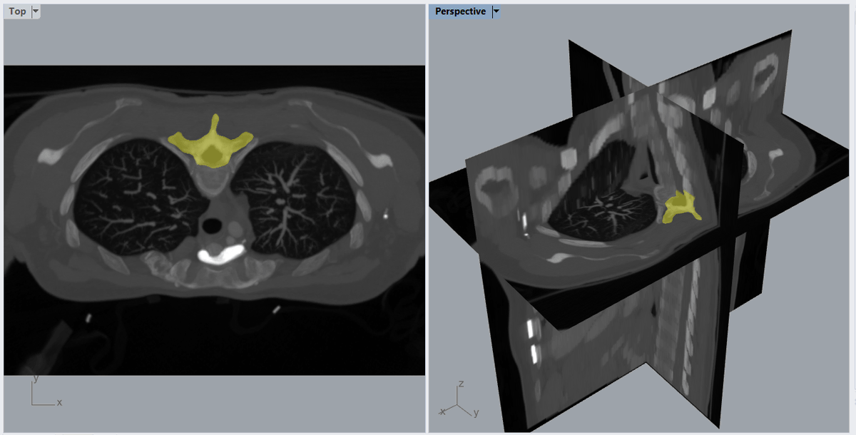 Manual Segmentation with <a href="/rhino3dmedical/">Rhino3DMedical</a>:
mirrakoi.com/2019/10/01/man…
Try it for free: mirrakoi.com/rhino3d-medica…
<a href="/McNeelEurope/">McNeelEU Rhino3D</a>