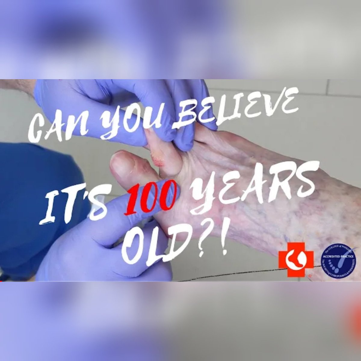 How do you take care of a century old pair of feet!?

Being old brings with it a host of physical problems and the feet are no exception. In our most recent video you can see how we debride and reduce a persistent, painful corn. 

youtu.be/HjMCMqqPp0w