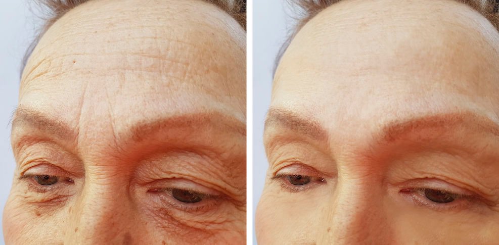 DrGranado's tweet photo. Cada vez son mas los pacientes que buscan un rejuvenecimiento facial #sincirugia y por ello hemos incorporado en @DrGranado el láser @scitonerbio, lo ultimo en tecnología no quirúrgica con resultados espectaculares en una sola sesión https://t.co/48bm3b1tlE https://t.co/jMgBHjJMkq