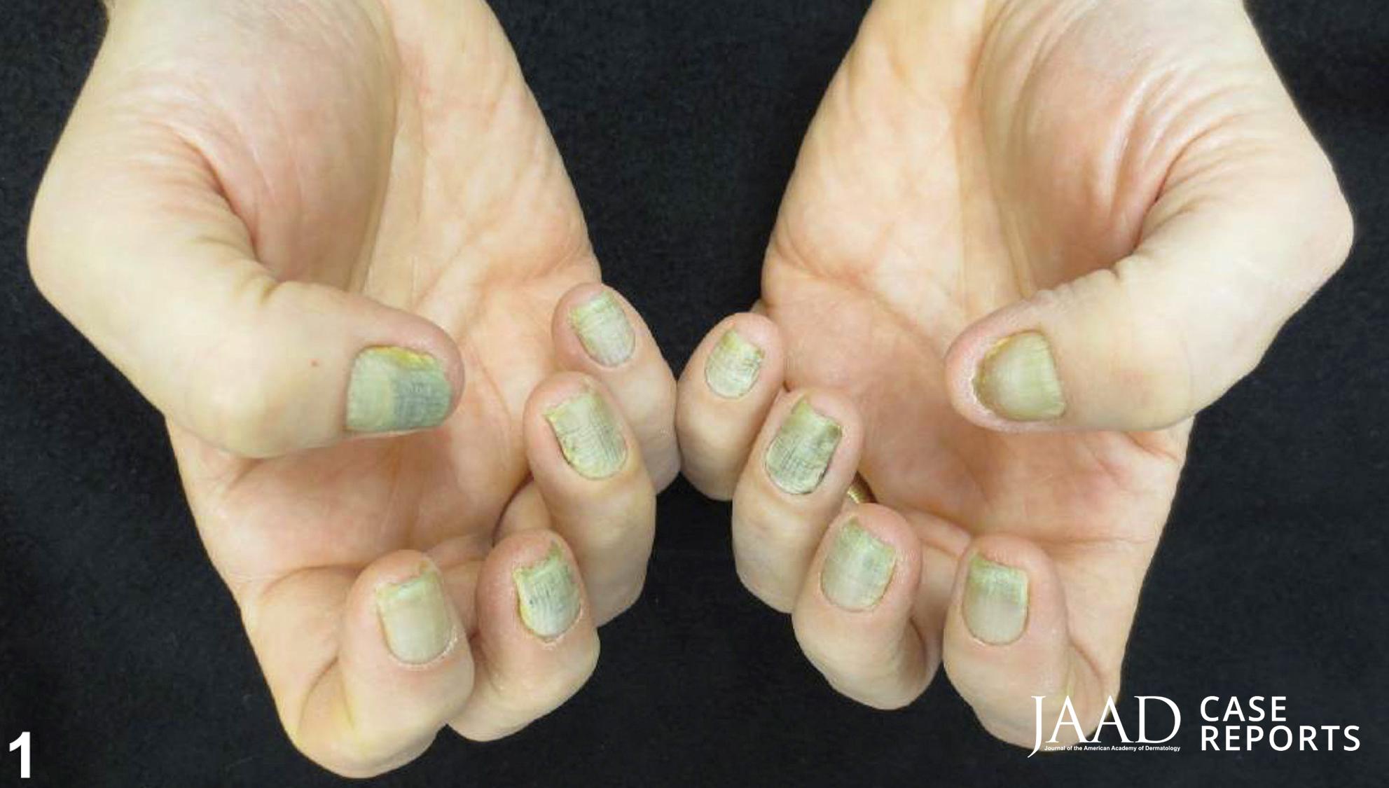 Pseudomonal Chloronychia - Green nails