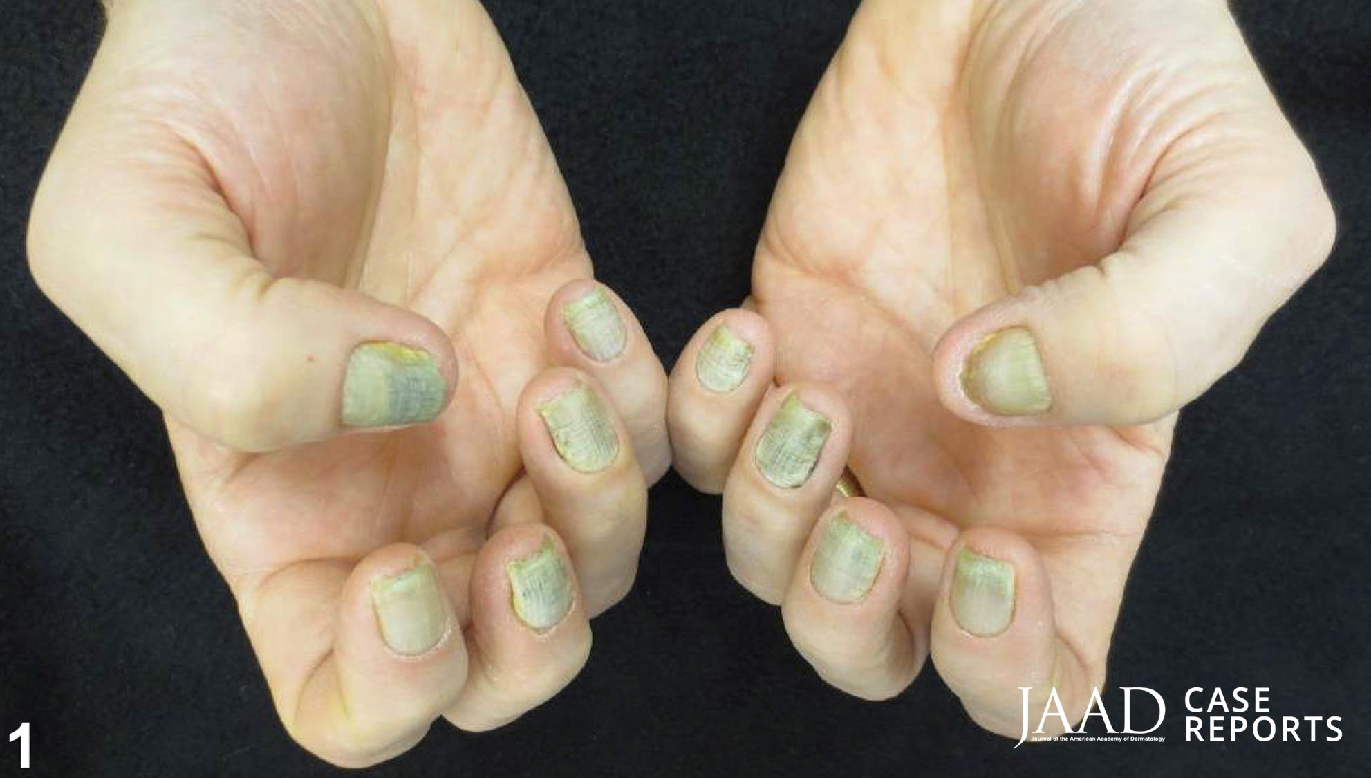 Is Nail Fungus Contagious? Preventing Toenail & Fingernail Fungus