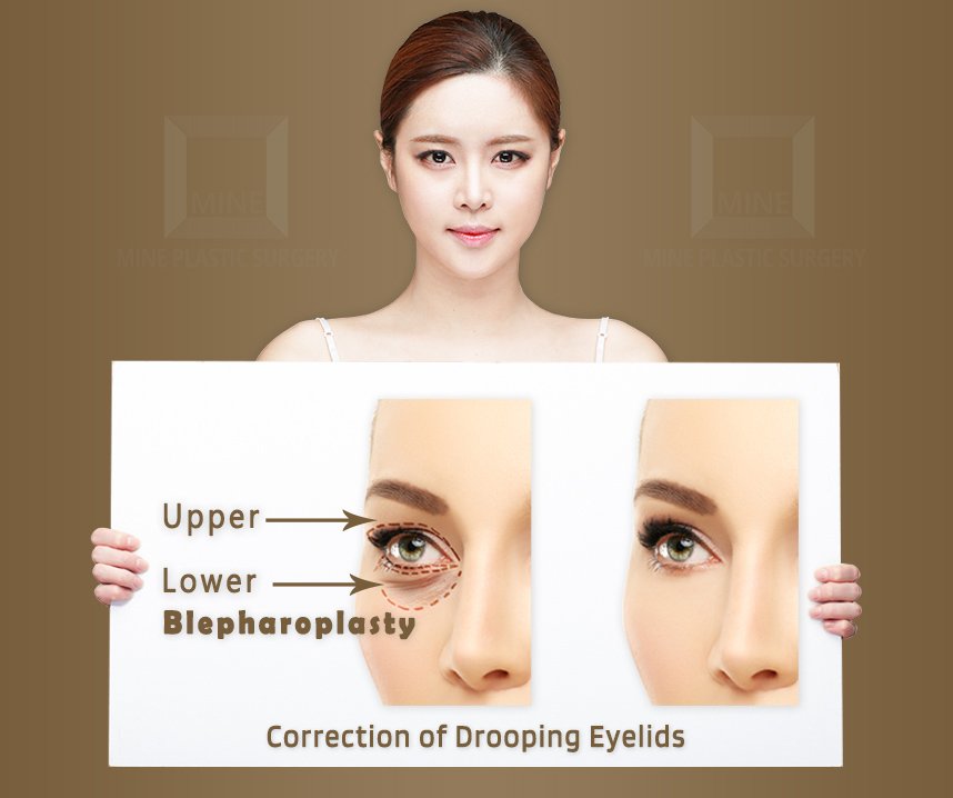 minepskr's tweet photo. Look more details about this surgery: https://t.co/aT818rIzoq
#lowerupperblepharoplasty
#mineclinicplasticsurgery
#eyesurgery #surgery #eyes
#doubleyelidoperation #eyelids
#droopingeyelids #lowereyesurgery
#uppersurgeryforeye #surgeryforcosts https://t.co/FDpzpXUlQn