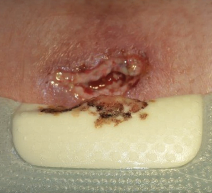Coloplast_WCare's tweet photo. Appropriate wound dressing should make close contact with:
A) the periwound skin
B) the wound bed
C) the necrotic tissue

An appropriate wound dressing should absorb and retain:
A) microorganisms
B) blood plasma
C) wound exudate

Write your answers below. #WoundWednesdays https://t.co/Z0V5Z3GAjr