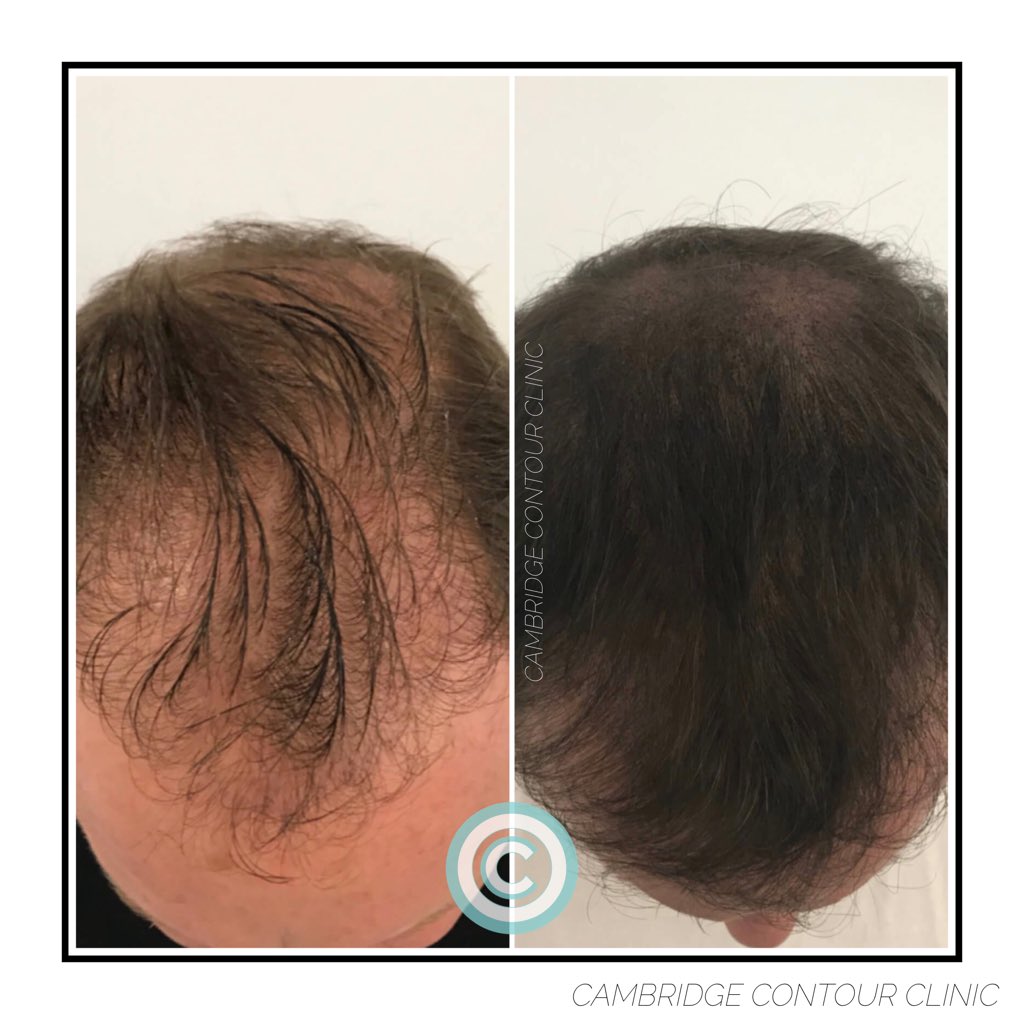 MeRefined's tweet image. Some before/after photos of recent Scalp Micropigmentation clients! 

#MeRefined #CCC #ScalpPigmentation #ScalpMicropigmentation #Tattoo #ScalpTattoo #CosmeticTattooing #HairThinning #Baldness #Alopecia #StandUpToCancer #Solutions #Cambridge #CambridgeCosmeticTattoo