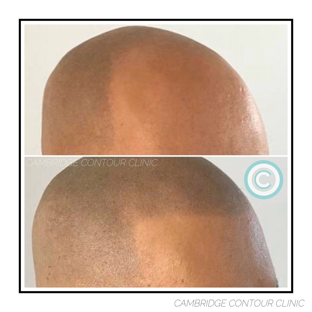 MeRefined's tweet image. Some before/after photos of recent Scalp Micropigmentation clients! 

#MeRefined #CCC #ScalpPigmentation #ScalpMicropigmentation #Tattoo #ScalpTattoo #CosmeticTattooing #HairThinning #Baldness #Alopecia #StandUpToCancer #Solutions #Cambridge #CambridgeCosmeticTattoo