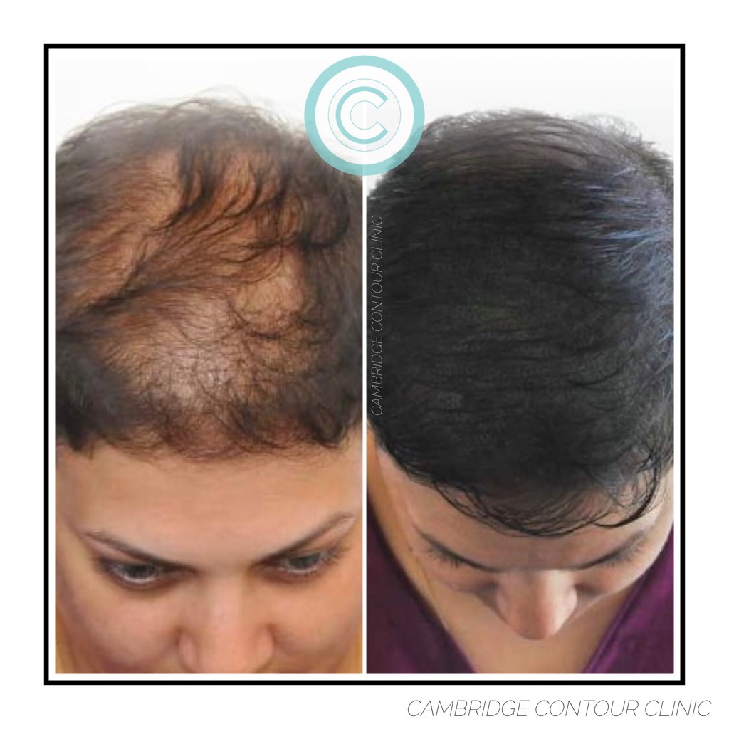 MeRefined's tweet image. Some before/after photos of recent Scalp Micropigmentation clients! 

#MeRefined #CCC #ScalpPigmentation #ScalpMicropigmentation #Tattoo #ScalpTattoo #CosmeticTattooing #HairThinning #Baldness #Alopecia #StandUpToCancer #Solutions #Cambridge #CambridgeCosmeticTattoo