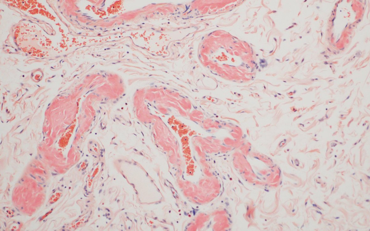 mcwpathology's tweet image. Elderly female with abdominal pain and distention, found to have bowel perforation and a surprise additional finding on histology #GIPath H&amp;amp;E &amp;gt; Congo Red &amp;gt; Polarized Congo Red. #PathResidents #Birefringence Thank you to Dr. Mostafa for the case and @glom_busterMD for the photos.