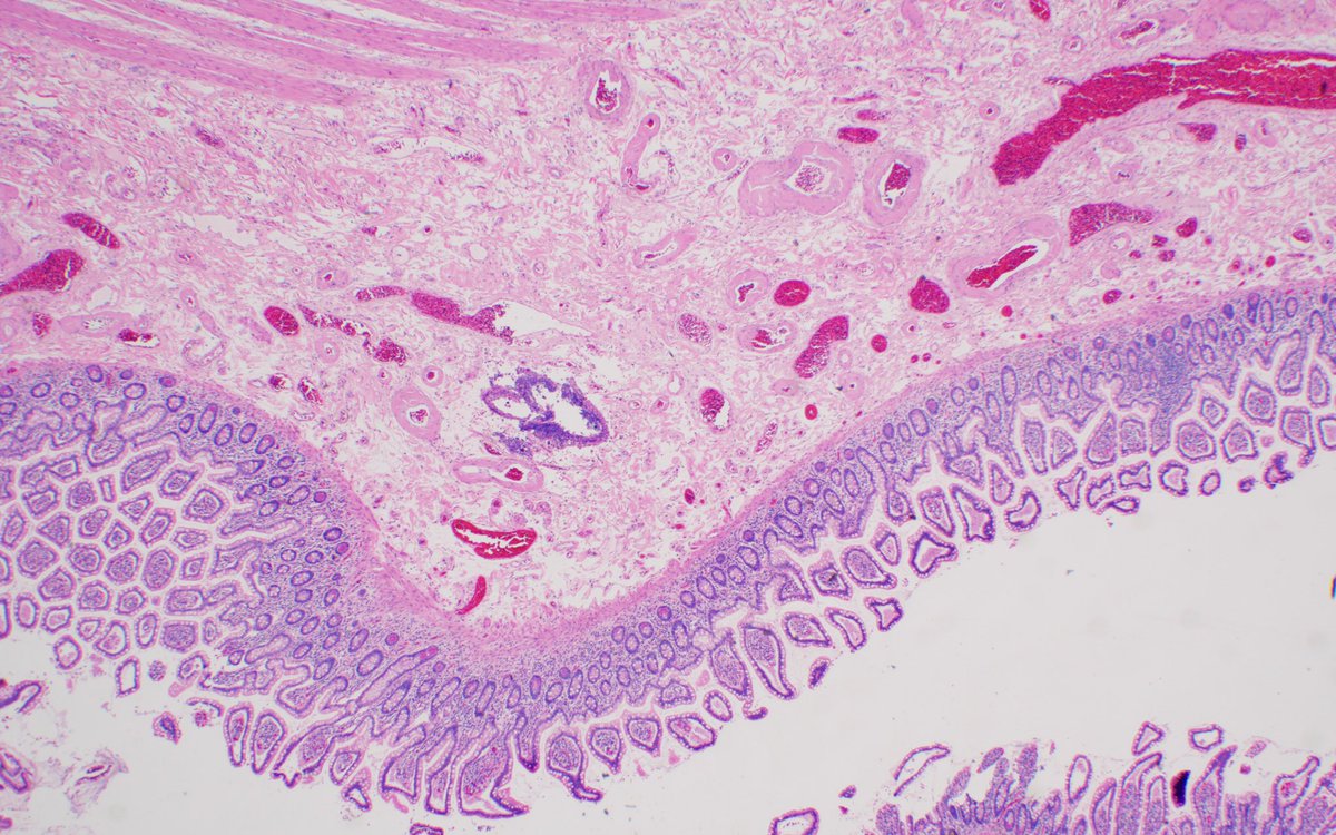 mcwpathology's tweet image. Elderly female with abdominal pain and distention, found to have bowel perforation and a surprise additional finding on histology #GIPath H&amp;amp;E &amp;gt; Congo Red &amp;gt; Polarized Congo Red. #PathResidents #Birefringence Thank you to Dr. Mostafa for the case and @glom_busterMD for the photos.