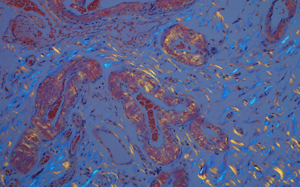 mcwpathology's tweet image. Elderly female with abdominal pain and distention, found to have bowel perforation and a surprise additional finding on histology #GIPath H&amp;amp;E &amp;gt; Congo Red &amp;gt; Polarized Congo Red. #PathResidents #Birefringence Thank you to Dr. Mostafa for the case and @glom_busterMD for the photos.