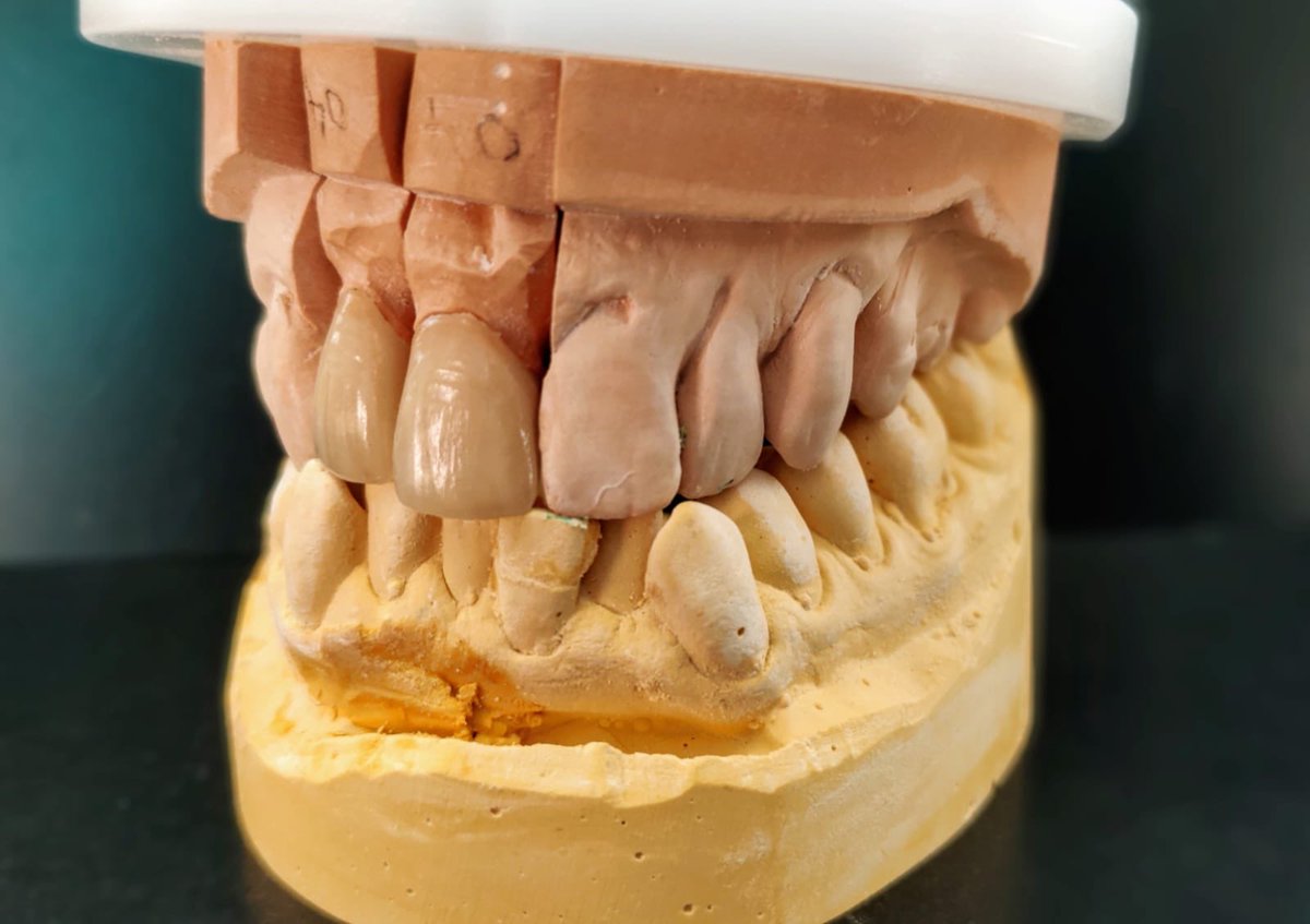 #2unit #emax 🤩 #emaxveneers #emaxpress #detailed #creative #naturalsmile #recreating #smiles #2frontteeth #dental #dentaltechnology #cosmeticdentistry #dentistry #dentist find out more about <a href="/optimum_dental/">Optimum Dental Lab</a> by going to the website wwww.optimumdental.co.uk