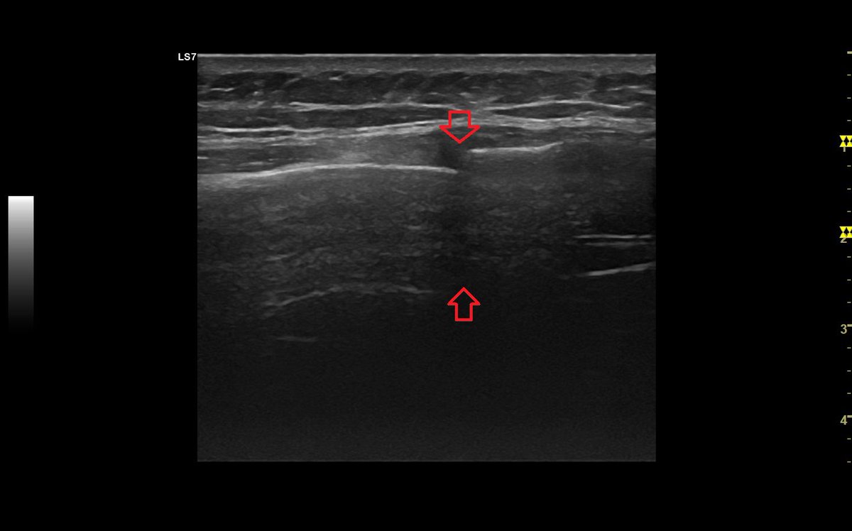 SportklinikBern's tweet photo. Rip fracture after 4 weeks with callus formation in #mskus #ripfracture #boneultrasound - #pocus is a good follow up... https://t.co/d49O3KFHWE
