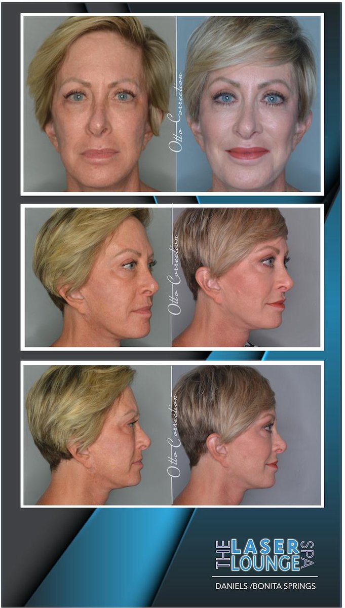 LLspadaniels's tweet photo. It’s your face. Be sure you trust your injector. Full face Otto-Correction before and after, for that natural look. Call today for free consultation. 239-245-8660.  #Ottocorrection #thelaserloungespadaniels #merzaesthetics #TLLS https://t.co/KLw16wUHiY